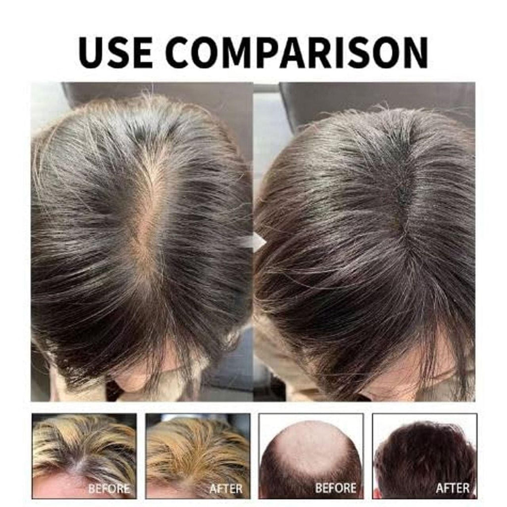 Hair Loss Treatment Serum 30Ml (Pack Of 1)